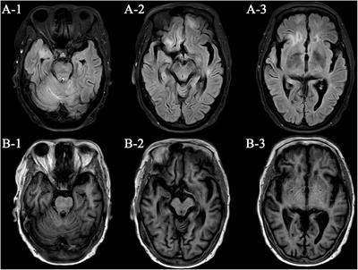 Refractory Status Epilepticus Responsive to Electroacupuncture at Shuigou Acupoint: A Case Report